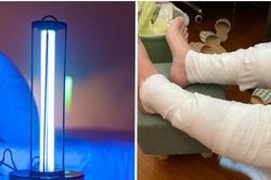 Một người Đài Loan bị bỏng nặng vì bật đèn UV diệt khuẩn trong phòng suốt 3 tiếng