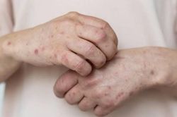 Đậu mùa khỉ lây qua đường tình dục?