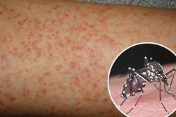 Số ca sốt xuất huyết tăng 75% so với năm ngoái, 29 ca tử vong