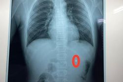 Nam sinh 16 tuổi bị đạn súng hơi bắn thấu thận