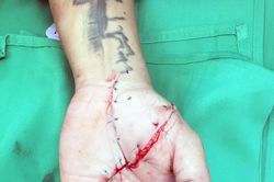 Xuyên đêm 'cứu sống' bàn tay một nam thanh niên bị đứt lìa