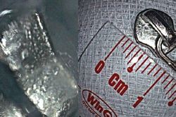 Phát hiện đầu khóa kéo trong dạ dày bé trai 6 tuổi