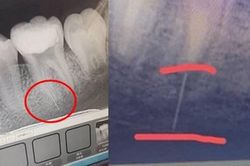 Điều trị tủy răng, bé gái bị nha sĩ làm chuyện rợn người