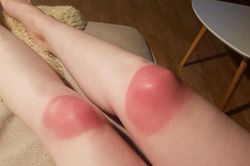Hàng loạt vết tích cháy nắng hài không đỡ được vì lỡ coi thường cái nắng hè