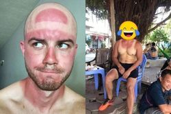 Coi thường mùa hè, netizen khoe chiến tích cháy nắng cực chất