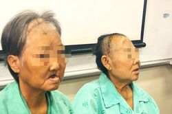 Hoại tử xương hàm mặt hậu COVID-19: Không phải bệnh lạ