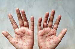 Nga không áp dụng các biện pháp chống dịch bệnh đậu mùa khỉ