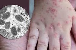 Đẩy mạnh giám sát dịch bệnh đậu mùa khỉ tại các cửa khẩu và các cơ sở khám chữa bệnh