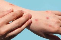 6 biện pháp phòng chống dịch bệnh đậu mùa khỉ