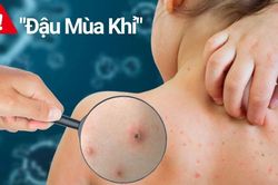 Gần 16.000 người mắc đậu mùa khỉ: Chuyên gia chỉ triệu chứng và cách phòng tránh