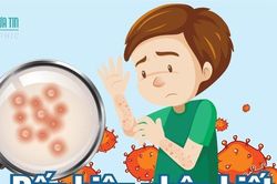 Info: Dấu hiệu nhận biết bệnh đậu mùa khỉ