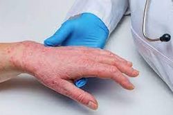 Người mắc đậu mùa khỉ thể nhẹ có thể tự khỏi sau 2-4 tuần
