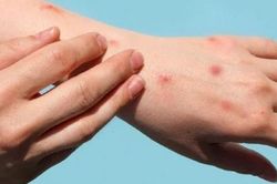 TPHCM muốn người nhập cảnh khai báo y tế để sàng lọc bệnh đậu mùa khỉ
