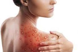 Mỹ có số ca mắc bệnh đậu mùa khỉ cao nhất thế giới