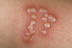 Nghiên cứu nguồn gốc căn bệnh viêm da phổ biến do nhiễm virus herpes