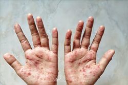Philippines ghi nhận trường hợp đầu tiên mắc bệnh đậu mùa khỉ