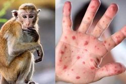 Hà Nội hướng dẫn chẩn đoán, điều trị và phòng bệnh đậu mùa khỉ