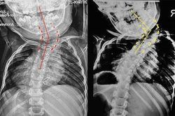 Bé trai 6 tuổi biến dạng cột sống do không chữa trị