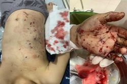 Pin đồ chơi phát nổ, bé 10 tuổi ở Quảng Ninh phải nhập viện