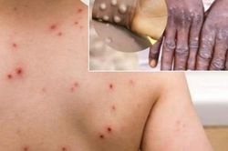 Chủ động nghiên cứu, sản xuất thuốc điều trị bệnh đậu mùa khỉ