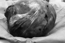 Lấy khối u nặng hơn 4 kg khỏi cơ thể người phụ nữ tại Cần Thơ
