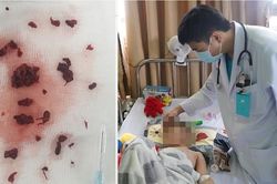 Cứu sống bé trai 4 tuổi bị đột quỵ não