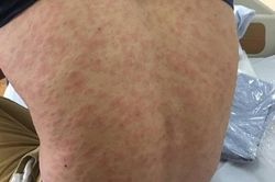 Sau ăn cá thu 30 phút, một phụ nữ phải nhập viện cấp cứu vì sốc phản vệ