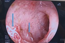 Cho con uống nước lắng phèn, trẻ 3 tháng tuổi bị xuất huyết tiêu hóa nặng