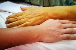 6 dấu hiệu trên cơ thể cảnh báo bệnh gan đã đi vào giai đoạn nặng, có 1/6 cũng nên đi khám gấp