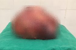 Bệnh viện Đa khoa tỉnh: Phẫu thuật thành công u tuyến thượng thận kích thước lớn
