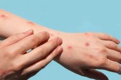 Thế giới Thế giới Virus đậu mùa khỉ có thể tồn tại trên bề mặt các đồ gia dụng thông thường