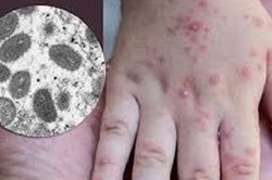 Đo thân nhiệt khách nhập cảnh để phát hiện sớm bệnh đậu mùa khỉ