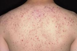 Suýt tử vong sau 30 phút lăn kim trị mụn ở spa