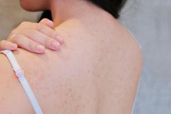 Rối loạn ý thức, suýt tử vong vì trị mụn ở lưng