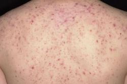 Suýt tử vong vì trị mụn trứng cá ở lưng tại một spa