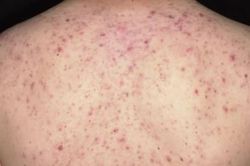 Người phụ nữ 36 tuổi suýt mất mạng vì đến spa trị mụn trứng cá ở lưng