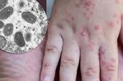 Hướng dẫn phòng ngừa lây nhiễm bệnh đậu mùa khỉ