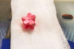 Chiếc kẹp tóc khiến bé gái bị viêm nhiễm vùng kín