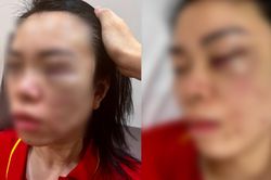 Giám định thương tật người phụ nữ bị chồng cũ đánh trong nhiều giờ