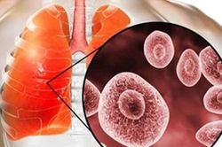 Yếu tố nguy cơ nhiễm nấm phổi do Aspergillus