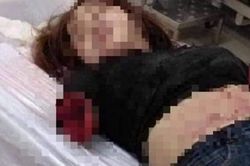 Vụ chém đứt lìa 2 tay vợ: Người nhà yêu cầu bác sĩ giữ kín mọi thông tin