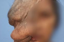 Cắt bỏ thành công khối u quái che nửa khuôn mặt cụ bà