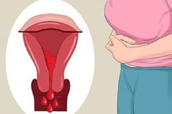 Làm gì khi có dấu hiệu rong kinh?