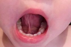 Phát hiện trẻ dính thắng lưỡi và những biện pháp can thiệp