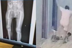 Hoàn cảnh gia đình bé trai bị mẹ đạp gãy xương đùi