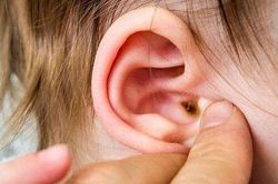 Biến chứng đáng sợ của viêm tai giữa và cách phòng tránh từ chuyên gia