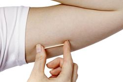 Que tránh thai 'đi lạc' sâu vào cơ bắp tay người phụ nữ
