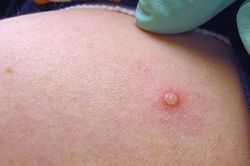 Bệnh đậu mùa khỉ lây truyền qua những đường nào?