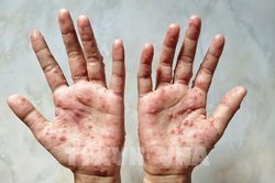 Việt Nam có ca đậu mùa khỉ đầu tiên, người dân cần làm gì để phòng bệnh?