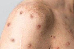 Phát hiện ca đậu mùa khỉ đầu tiên tại Thành phố Hồ Chí Minh